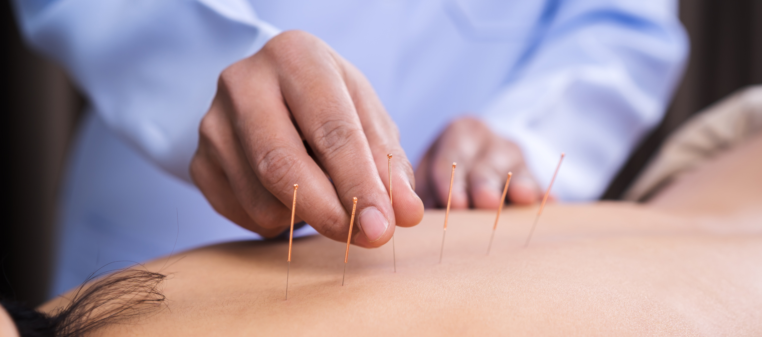 Dry Needling in Dallas for Effective At-Home Pain Relief and Recovery
