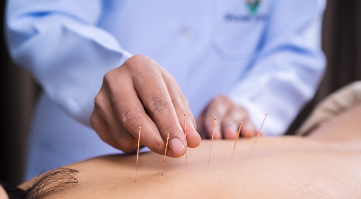 Dry Needling in Dallas for Effective At-Home Pain Relief and Recovery