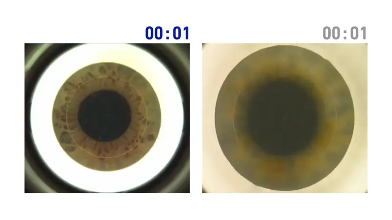 스마일라식 이벤트 혜택