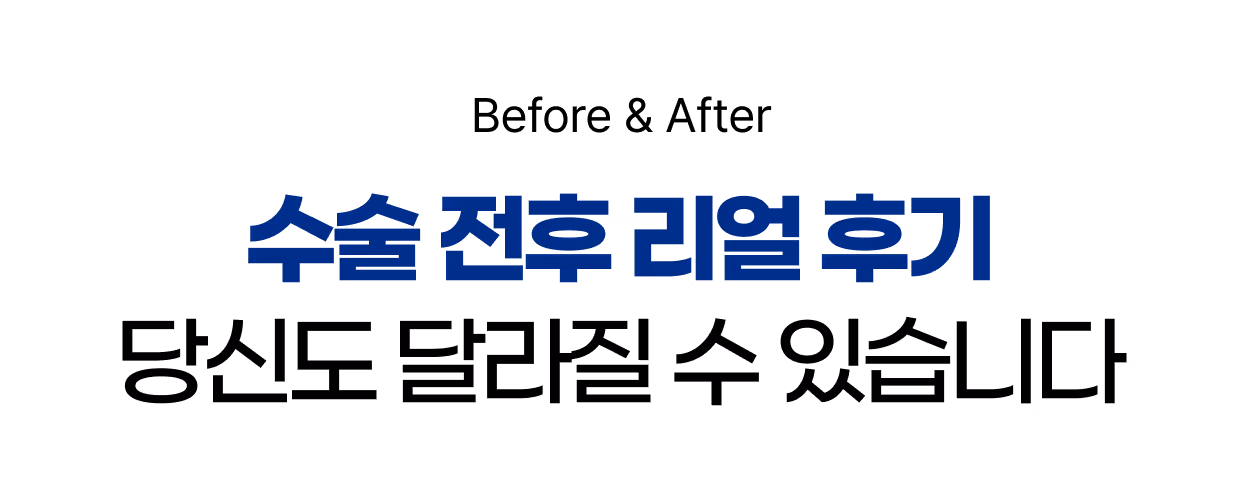 스마일라식 이벤트 혜택
