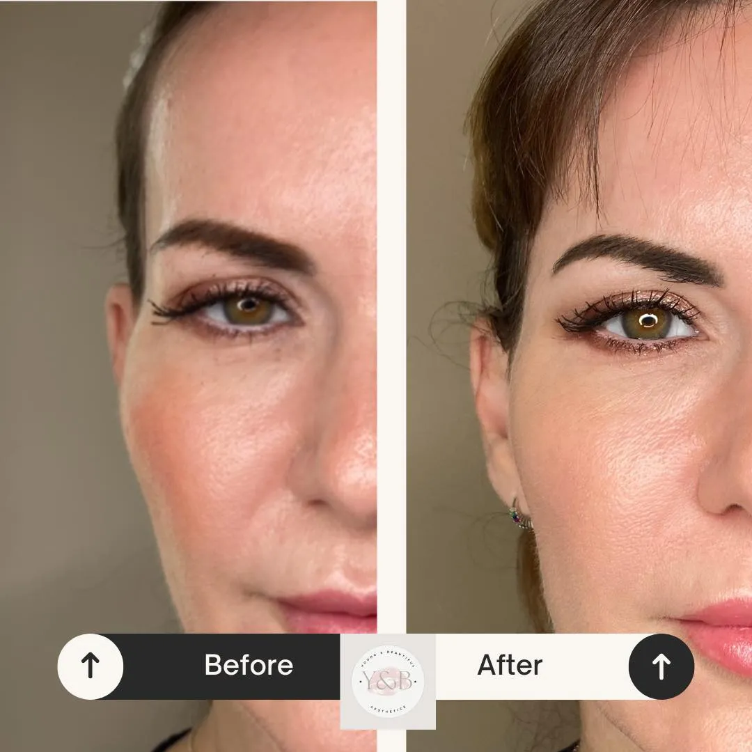 temple filler before and after example