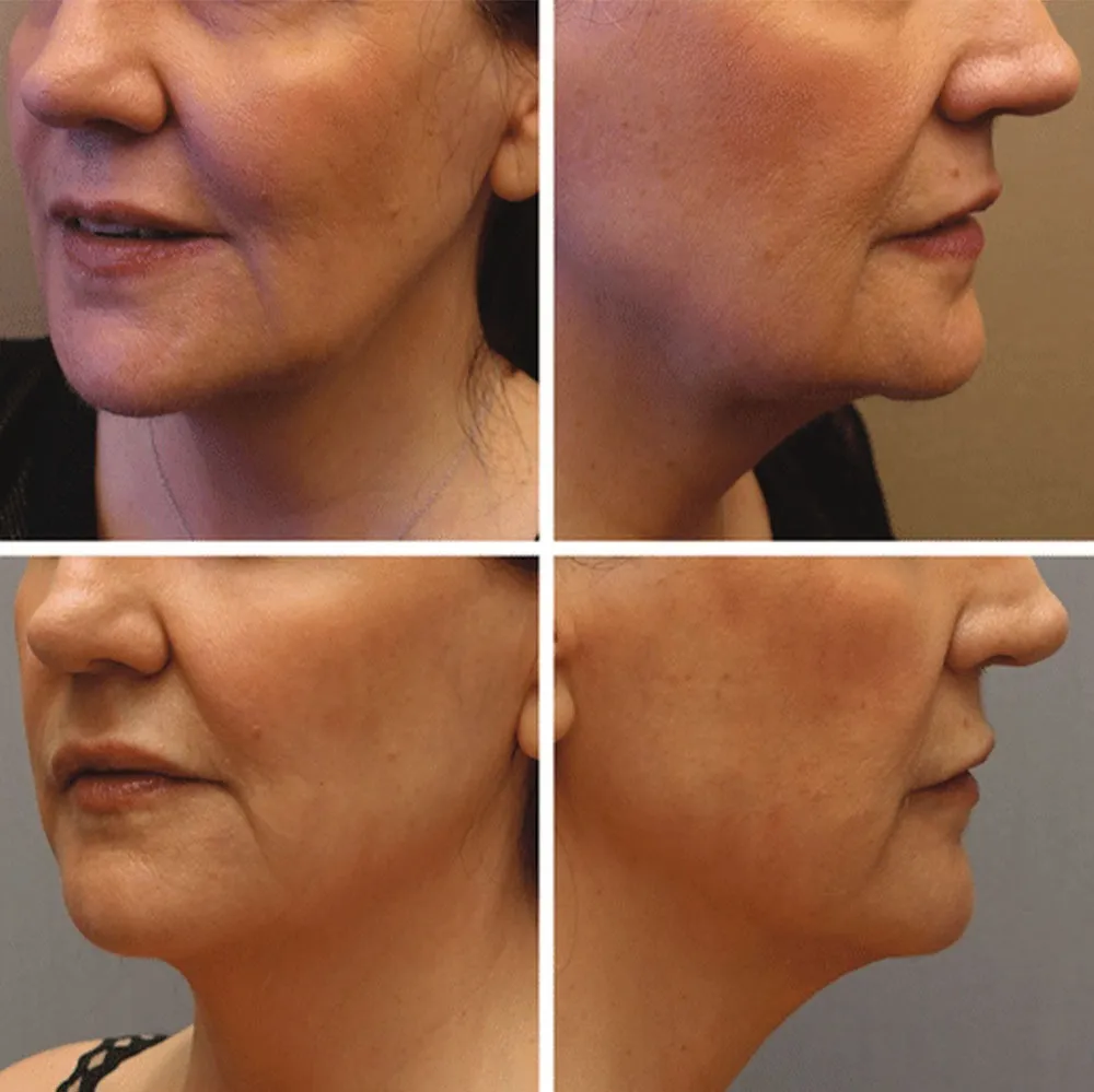 Sagging Jowls Before And After Real Results Hubmed