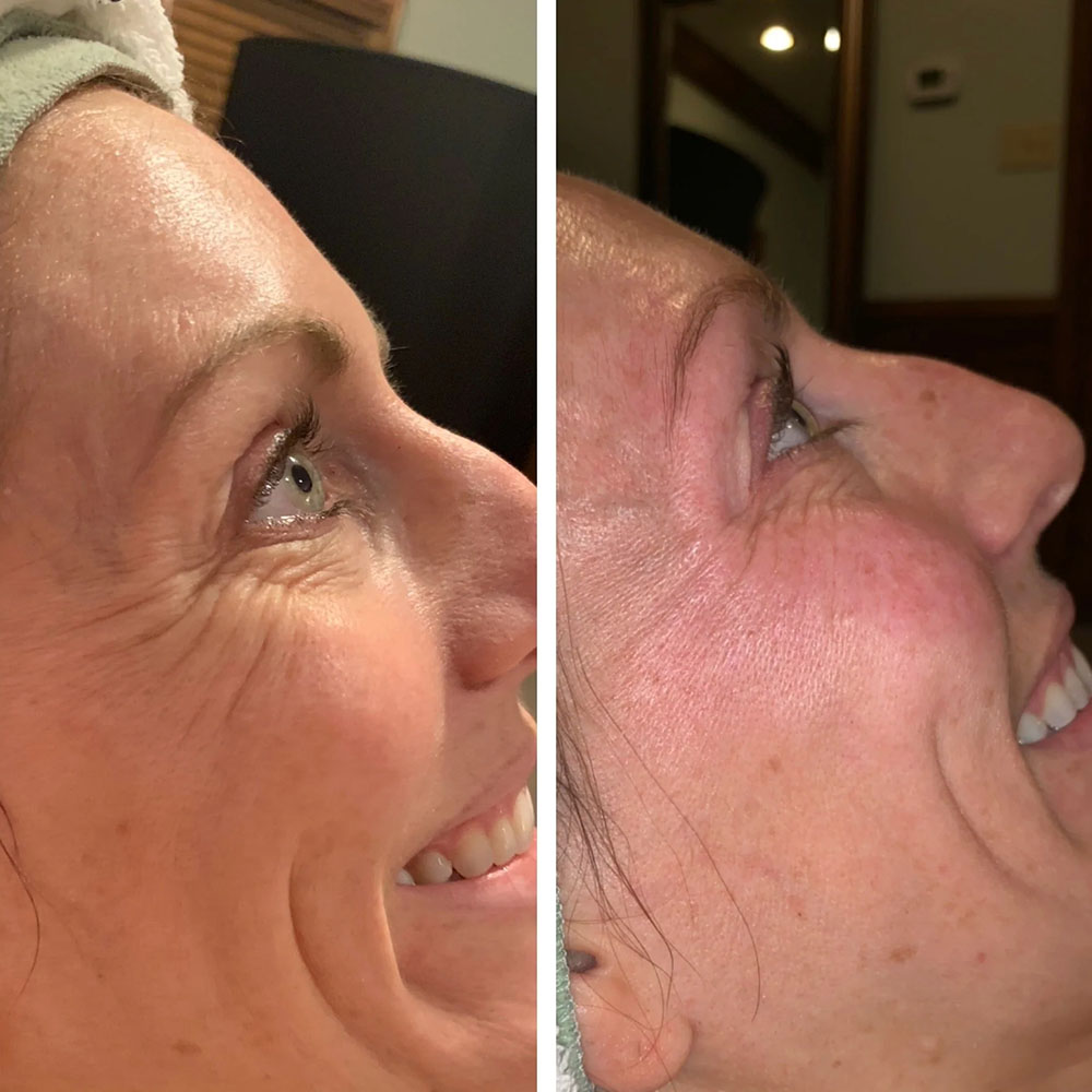copper peptides before and after