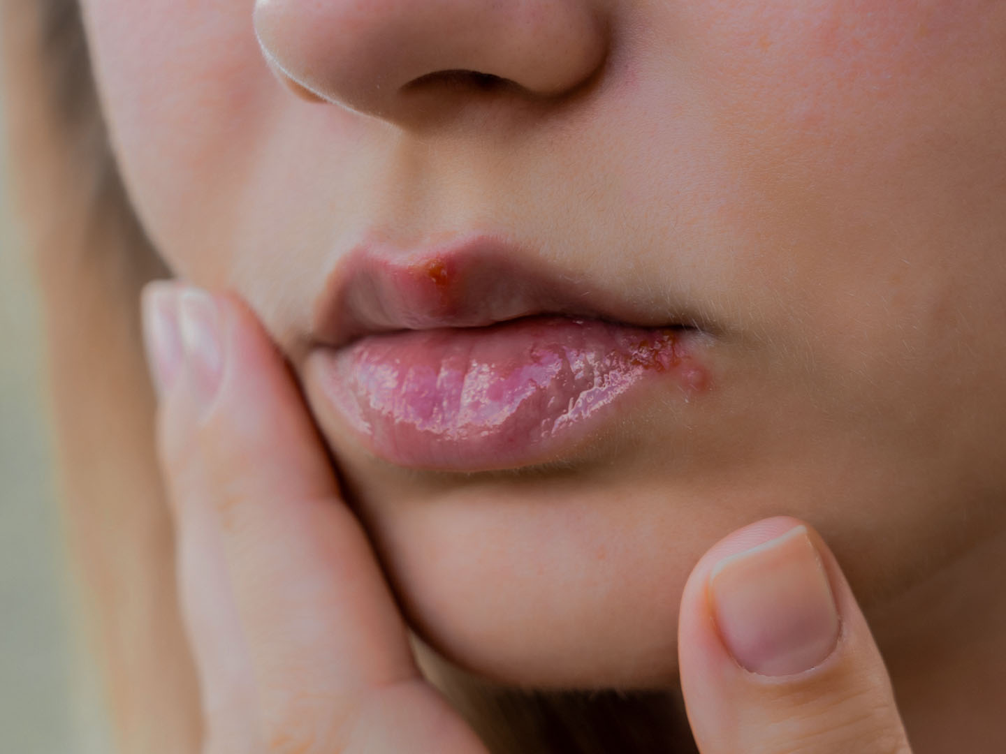 How to Recognize and Treat Allergic Reaction to Lip Filler