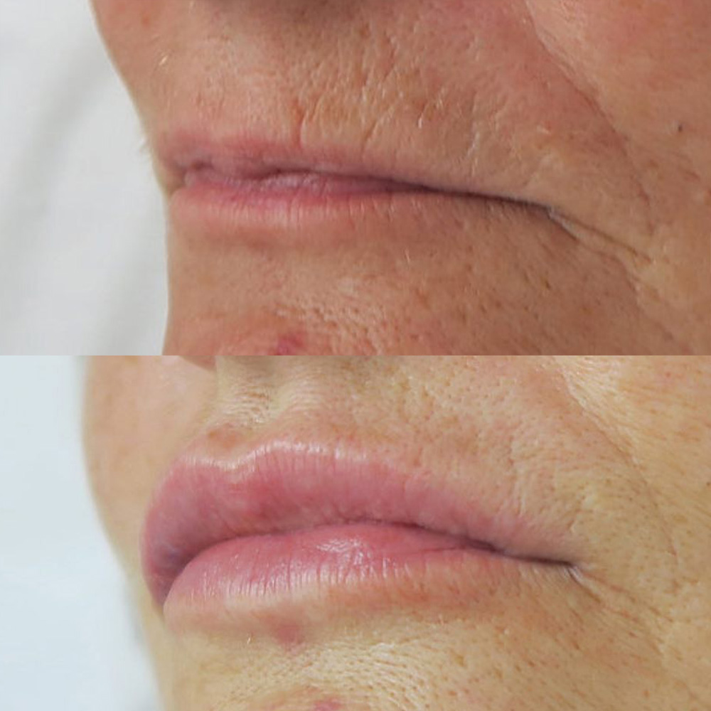 Juvéderm before and after