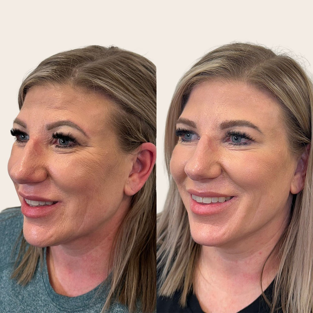 botox like peptide