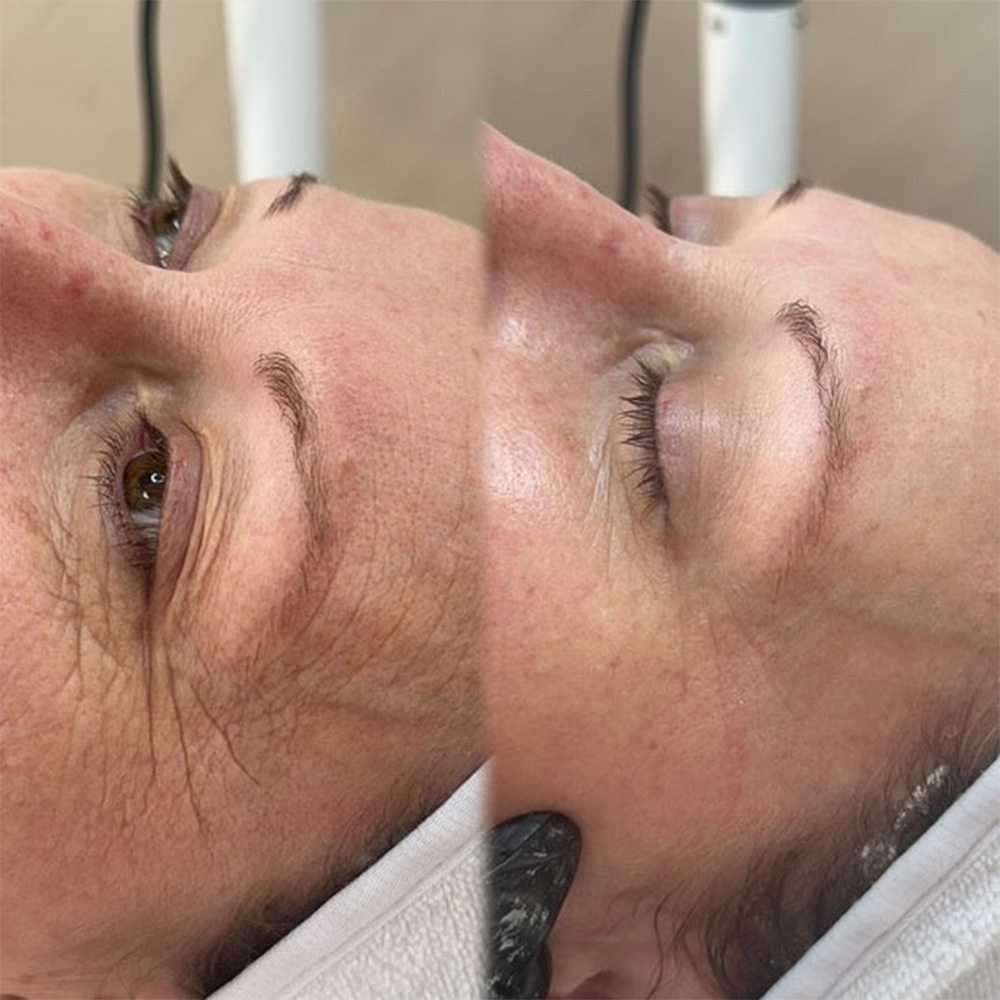 botox like peptide