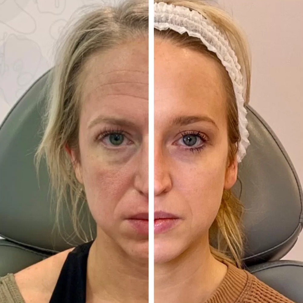 microneedling with sculptra before and after