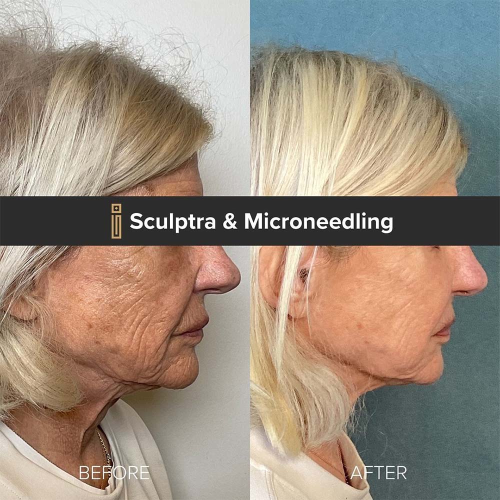 microneedling with sculptra before and after