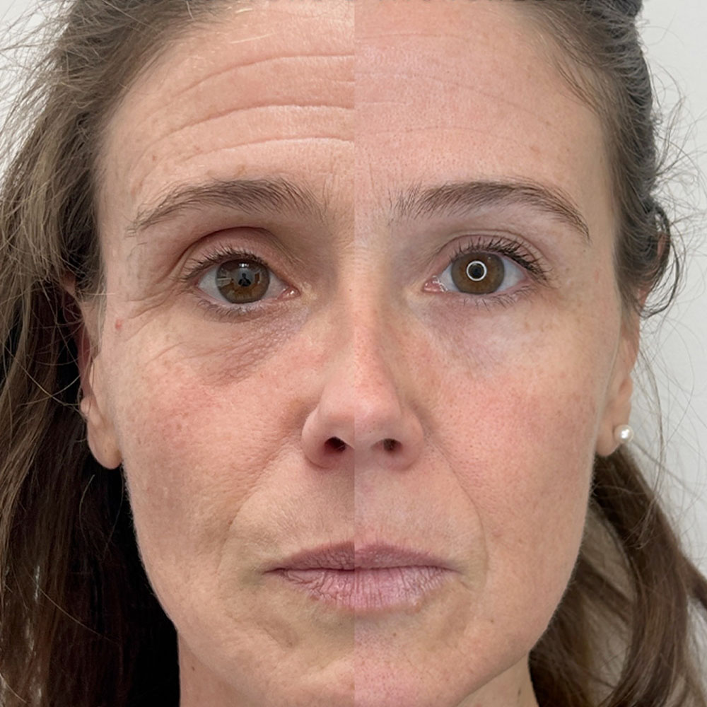 microneedling with sculptra before and after