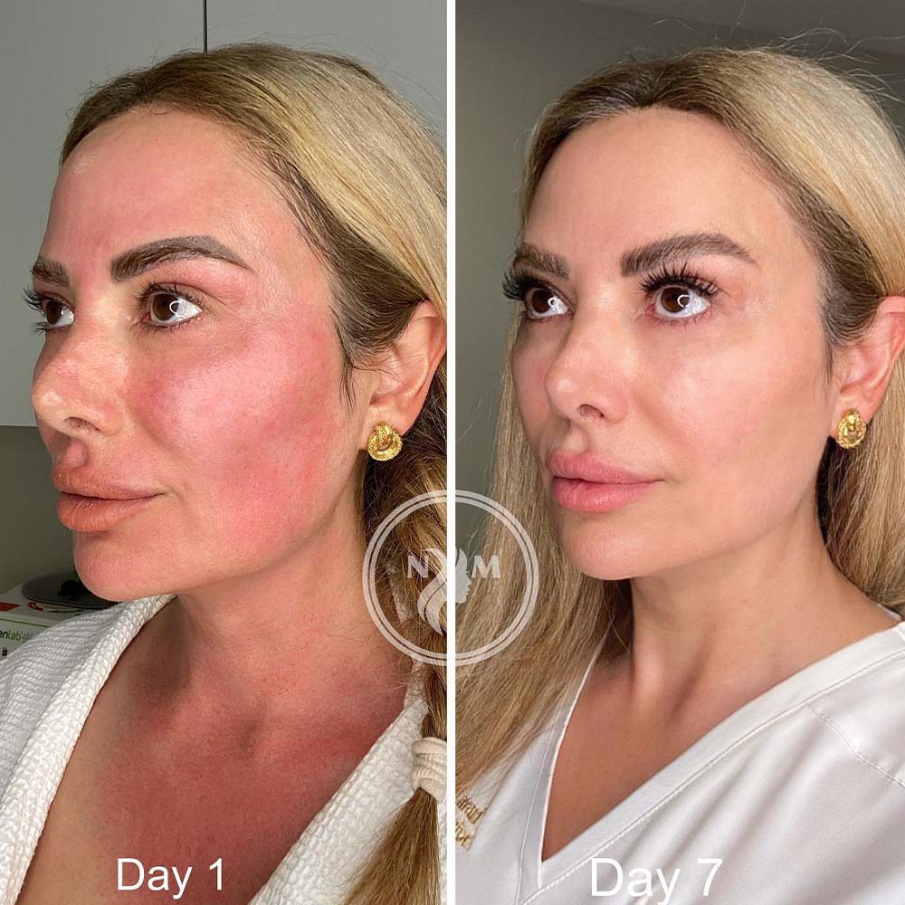 microneedling with sculptra before and after