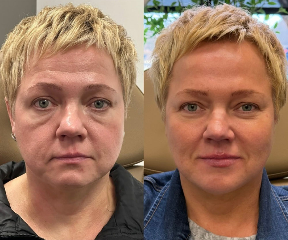Restylane vs Juvederm