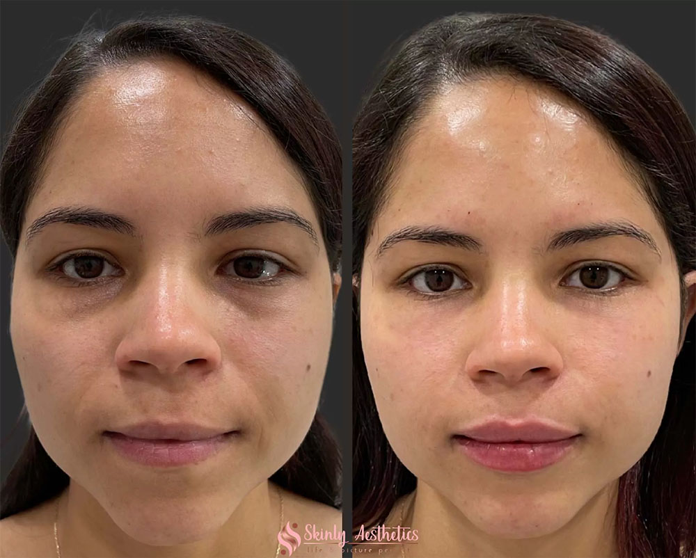 radiesse filler vs juvederm