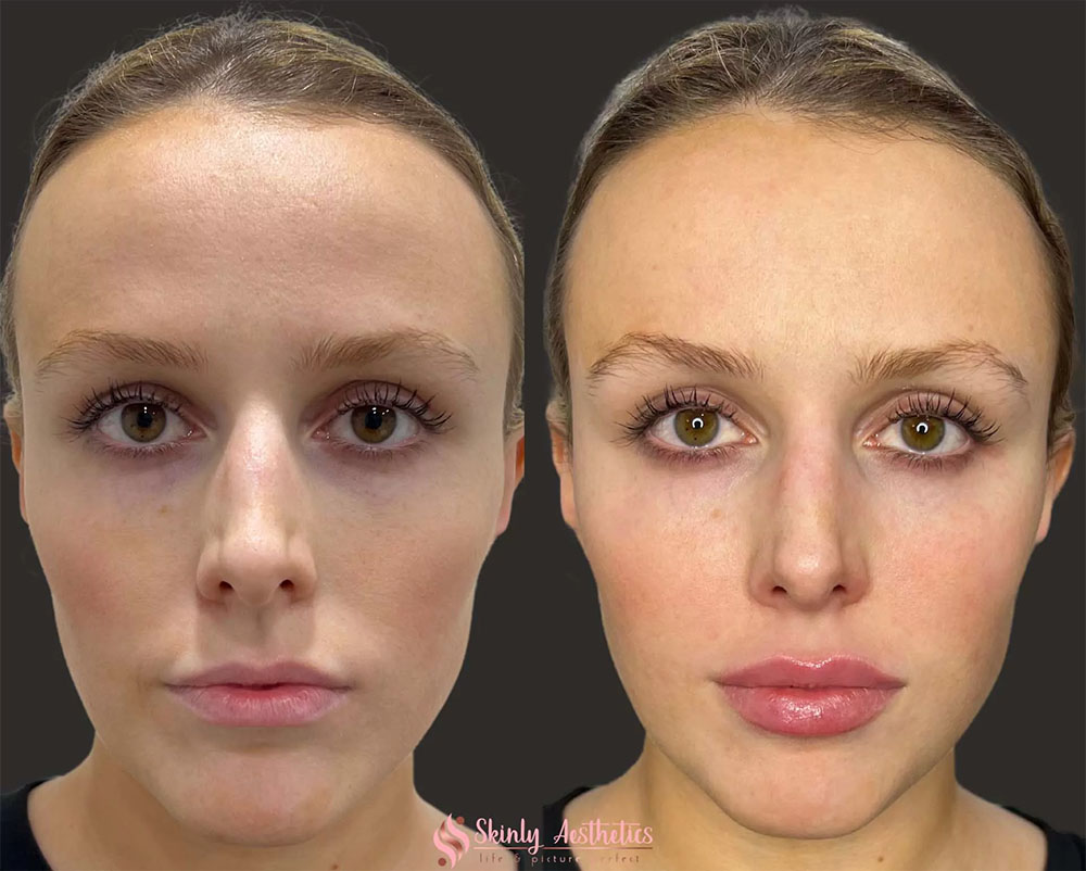 radiesse filler vs juvederm
