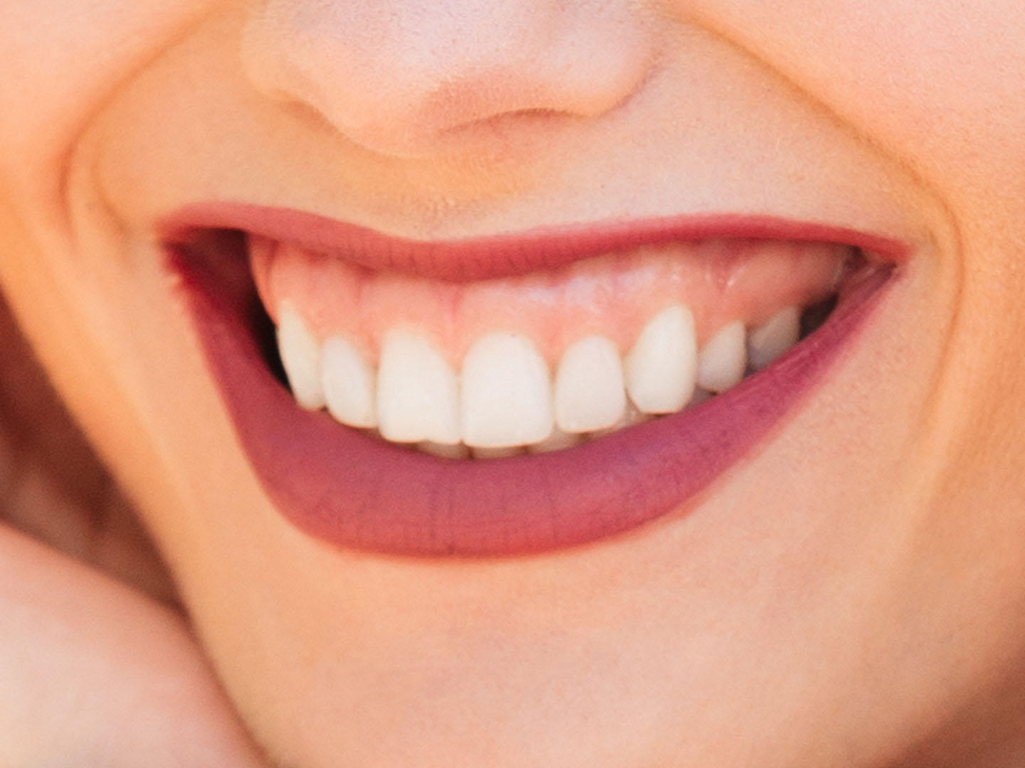 Juvederm for Gummy Smile: Correction Guide