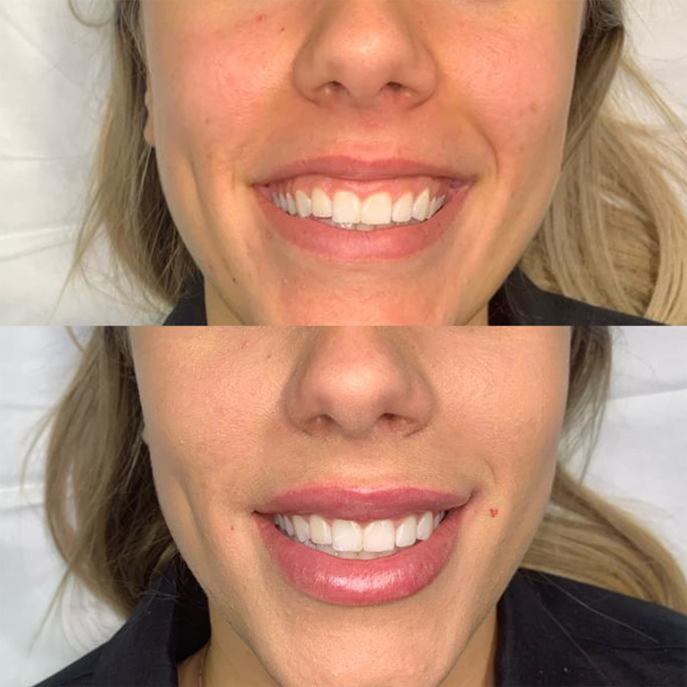 juvederm for gummy smile