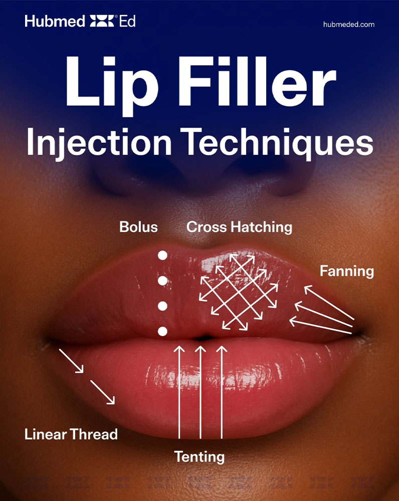 juvederm for gummy smile