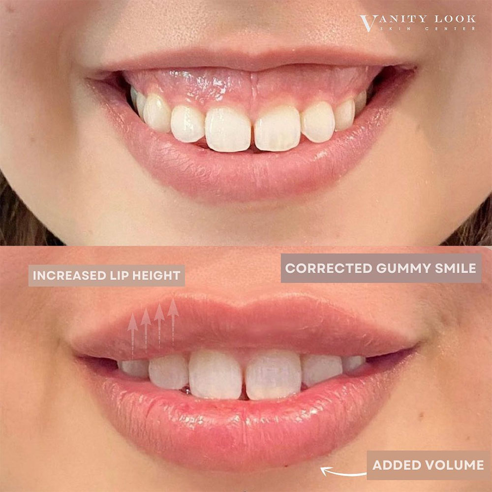 juvederm for gummy smile
