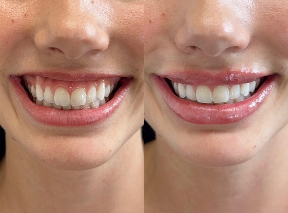 juvederm for gummy smile