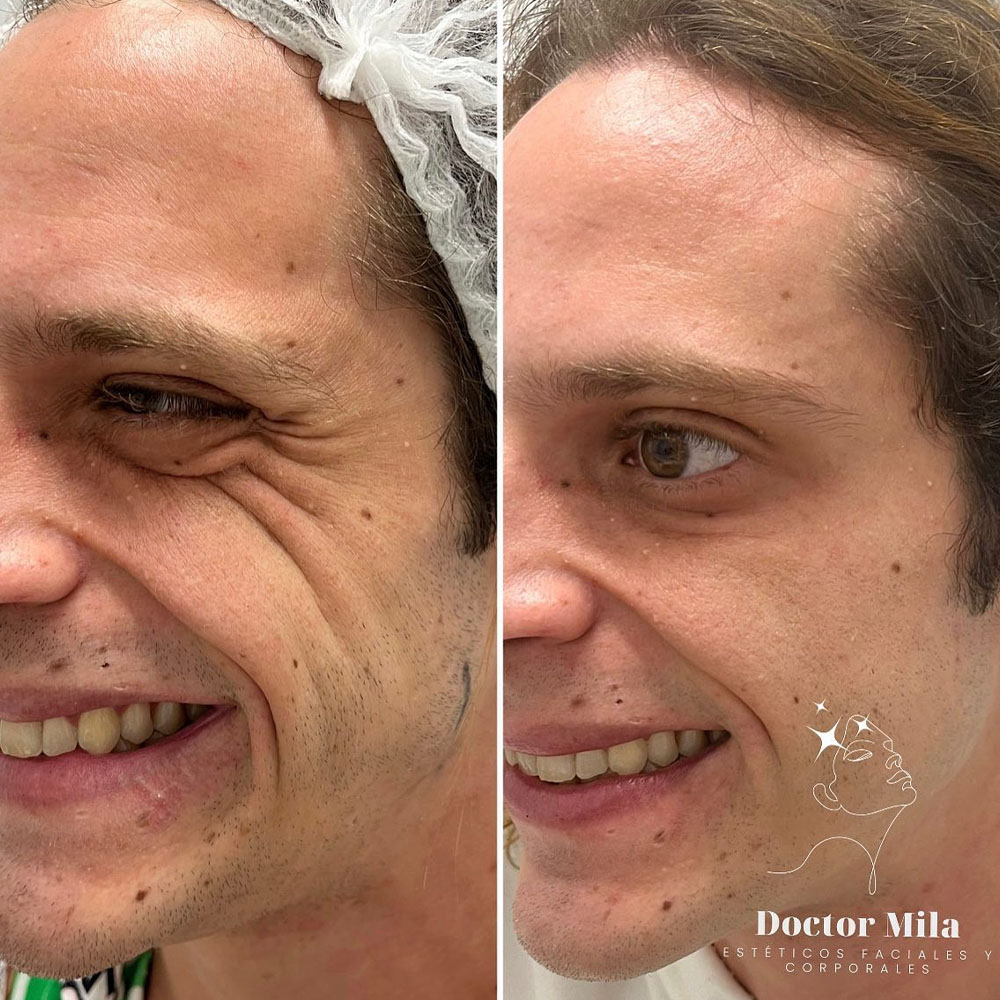 botox for under eye bags
