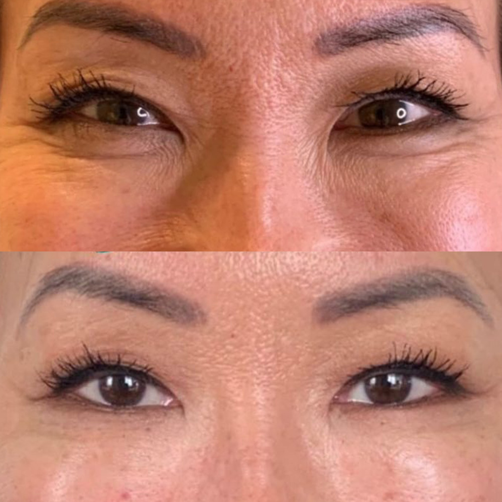 botox for under eye bags