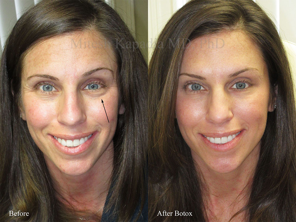 botox for under eye bags