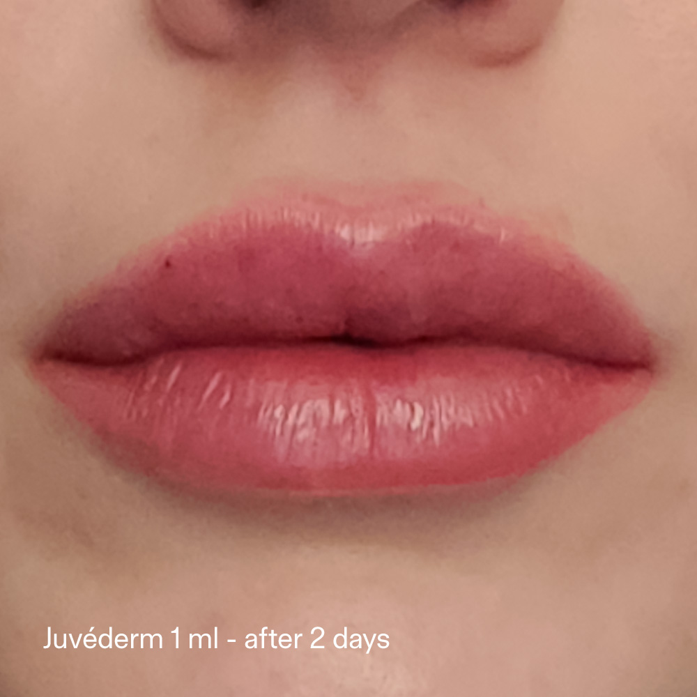 RHA Filler vs Juvéderm