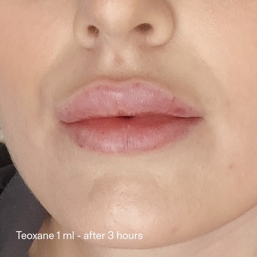 RHA Filler vs Juvéderm