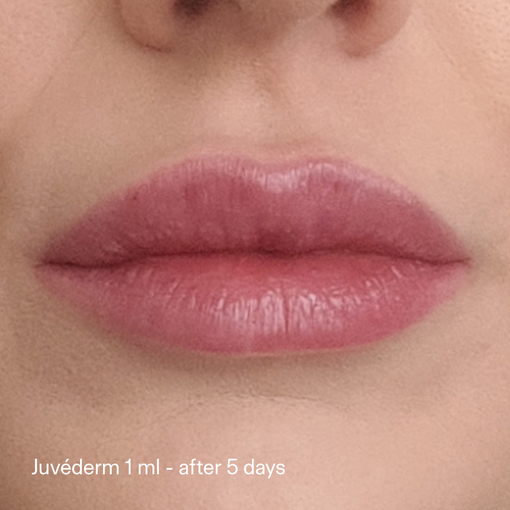 RHA Filler vs Juvéderm