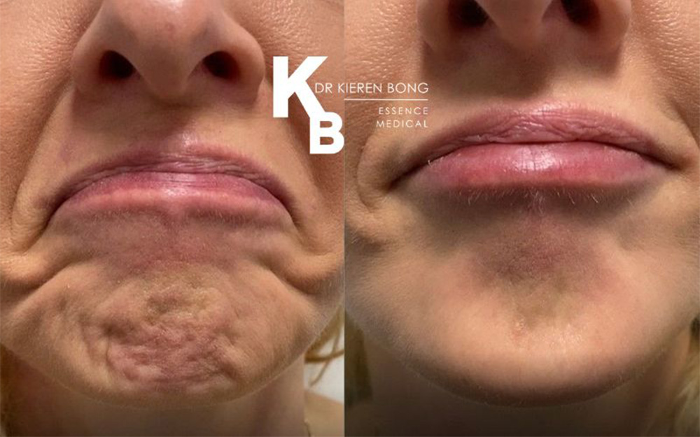 chin botox​