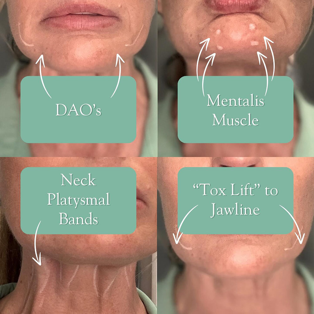 chin botox​