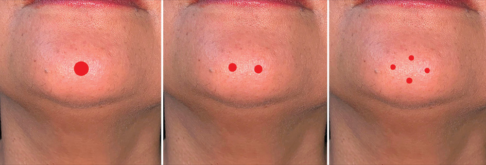 chin botox​
