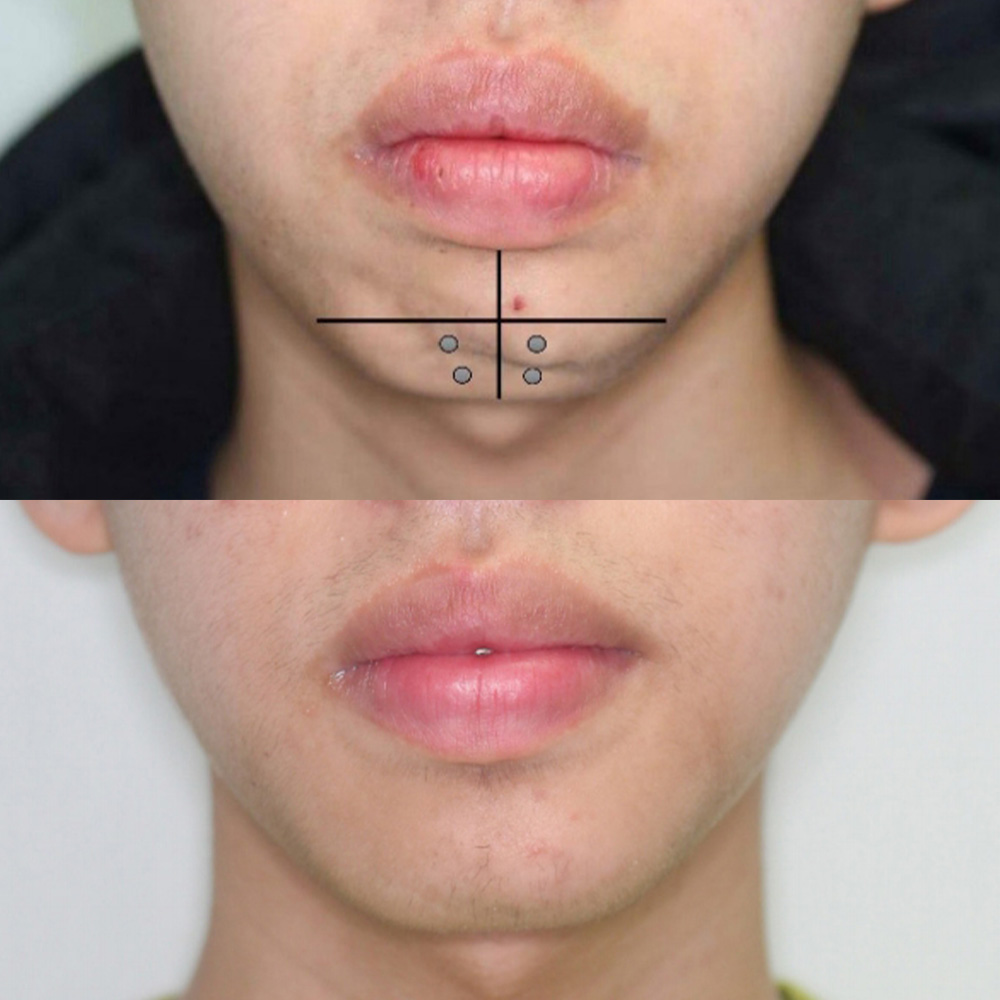 chin botox​