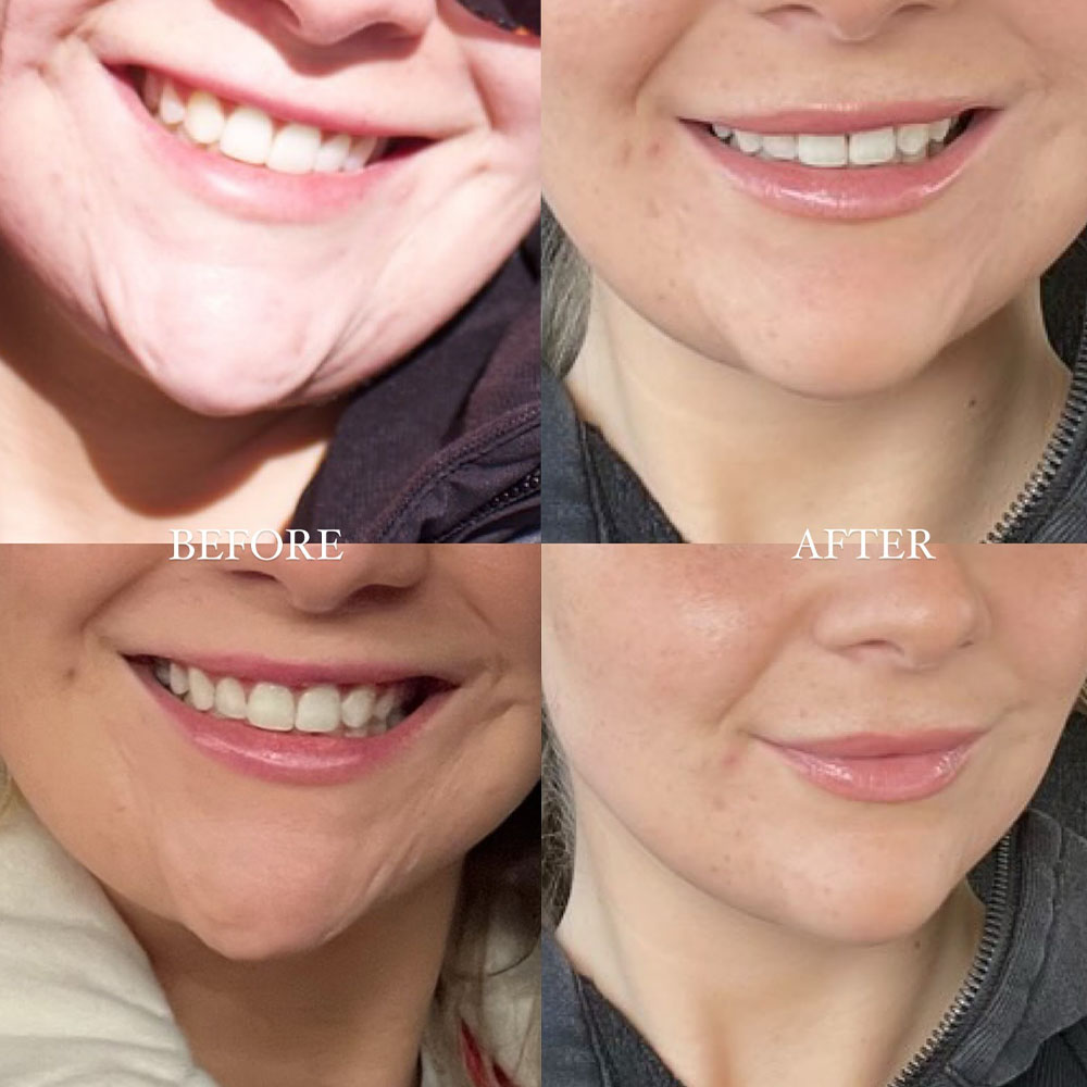 chin botox​