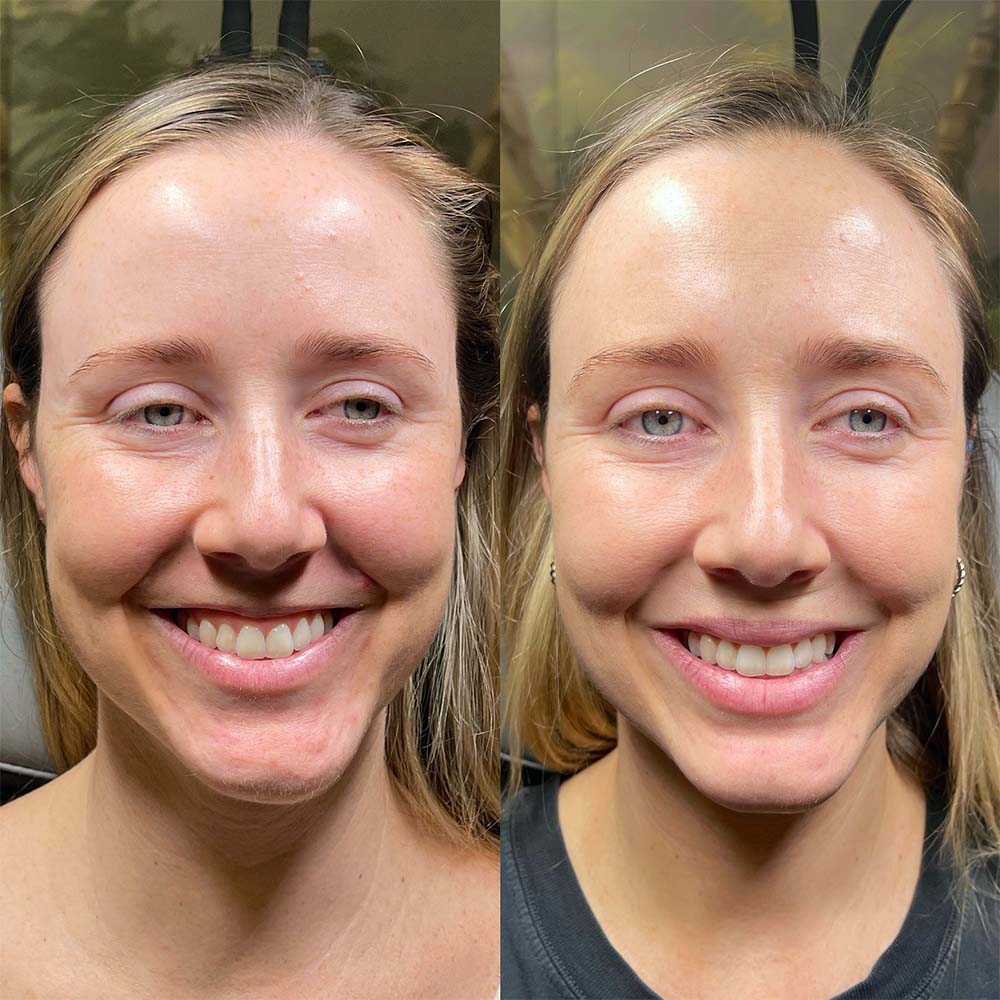 chin botox​