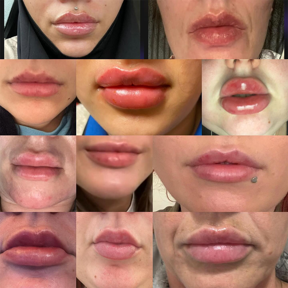 bad lip filler