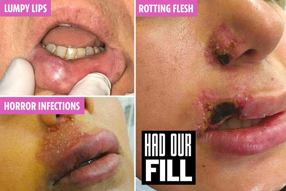 bad lip filler