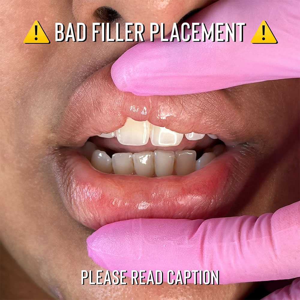 bad lip filler