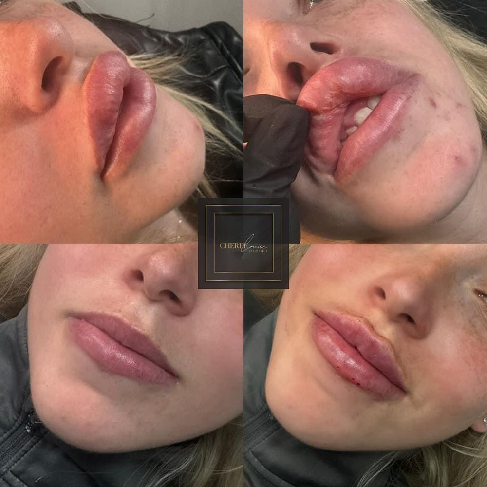 bad lip filler
