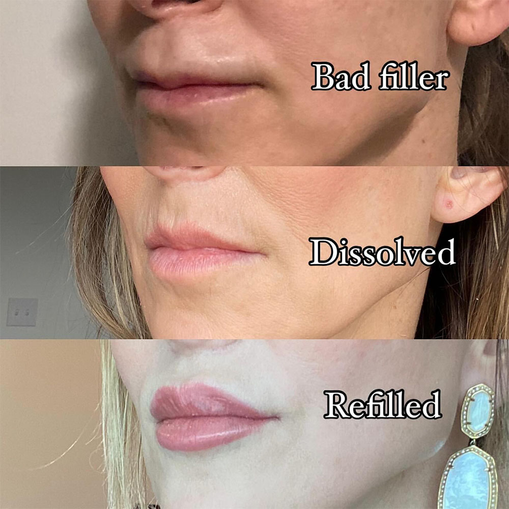 bad lip filler
