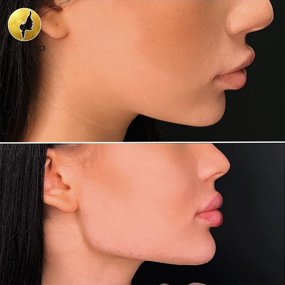 jawline contouring