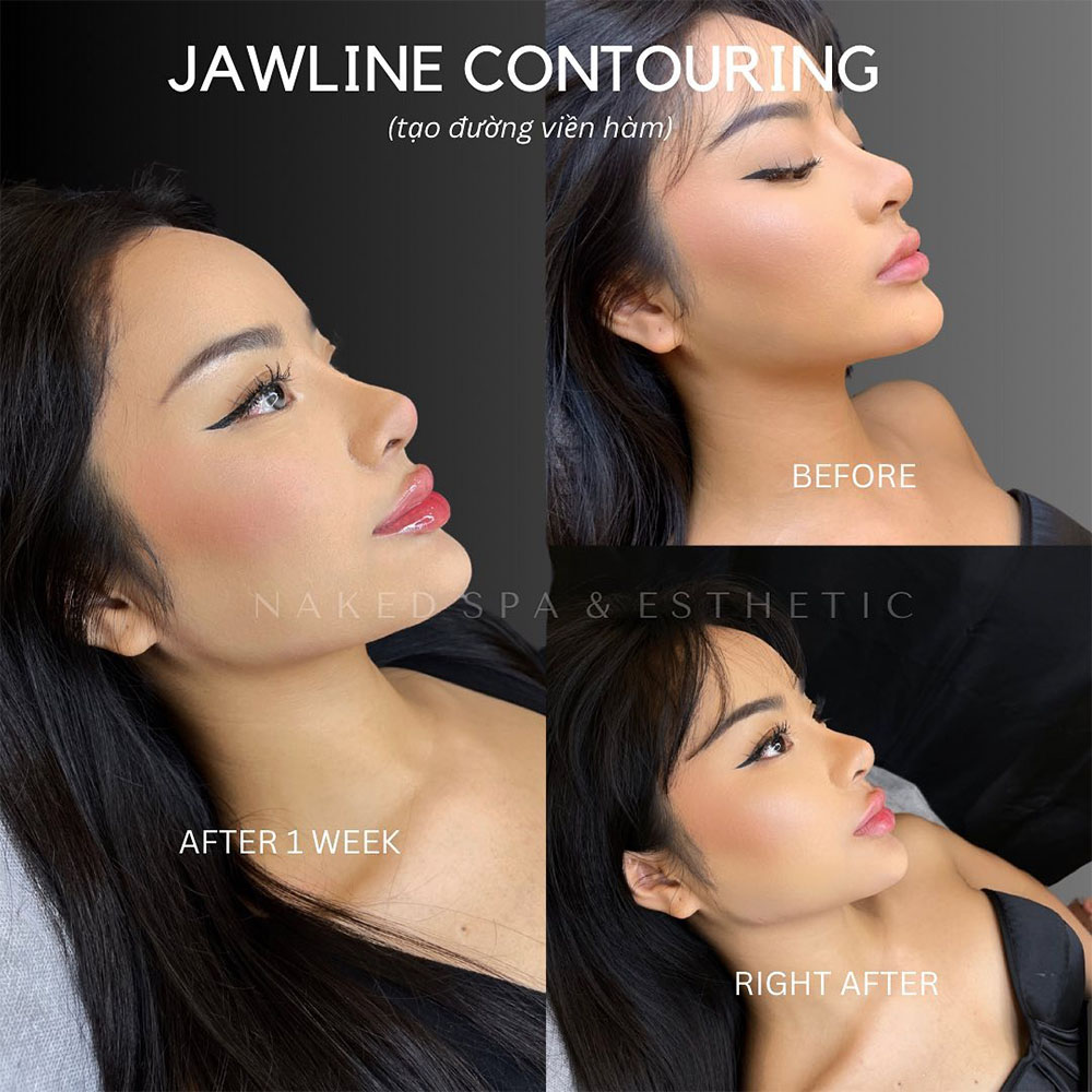 jawline contouring