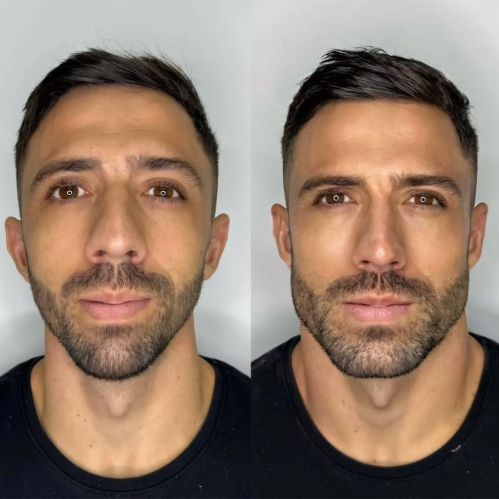 jawline contouring