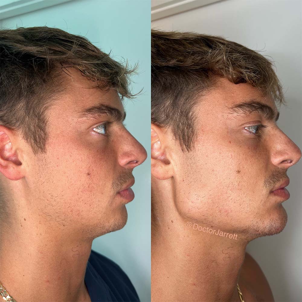 jawline contouring