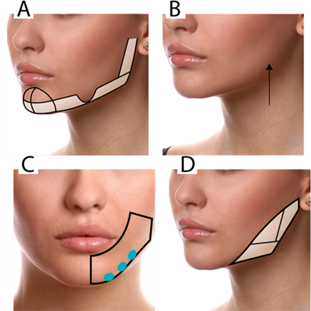 jawline contouring