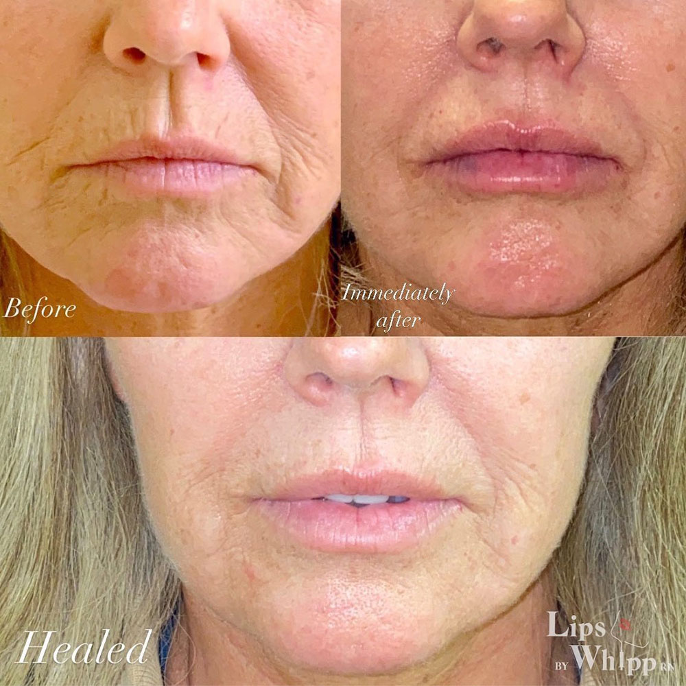 filler for vertical lip lines before and after