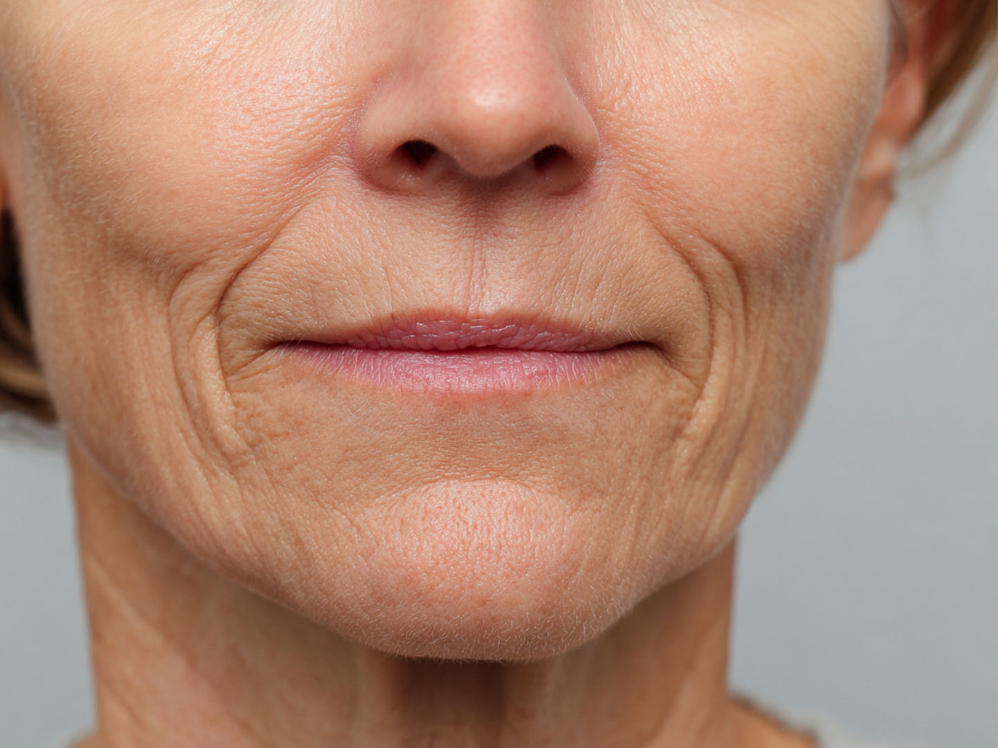 Filler for Vertical Lip Lines: Before and After Transformation