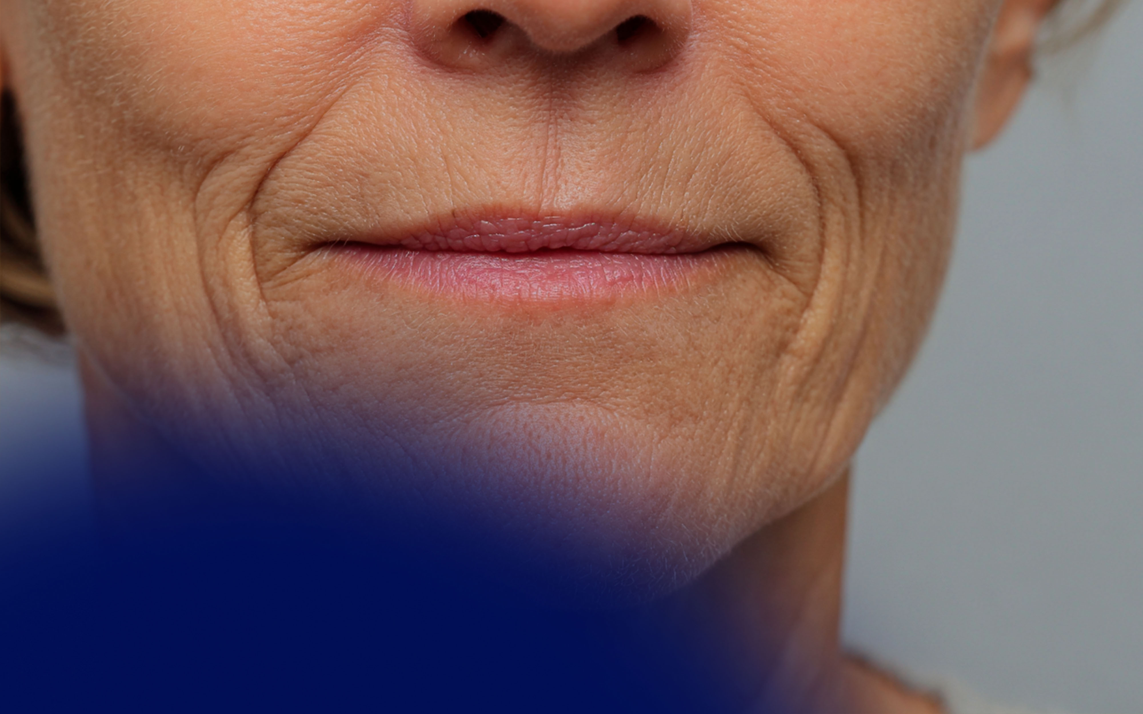 Filler for Vertical Lip Lines: Before and After Transformation