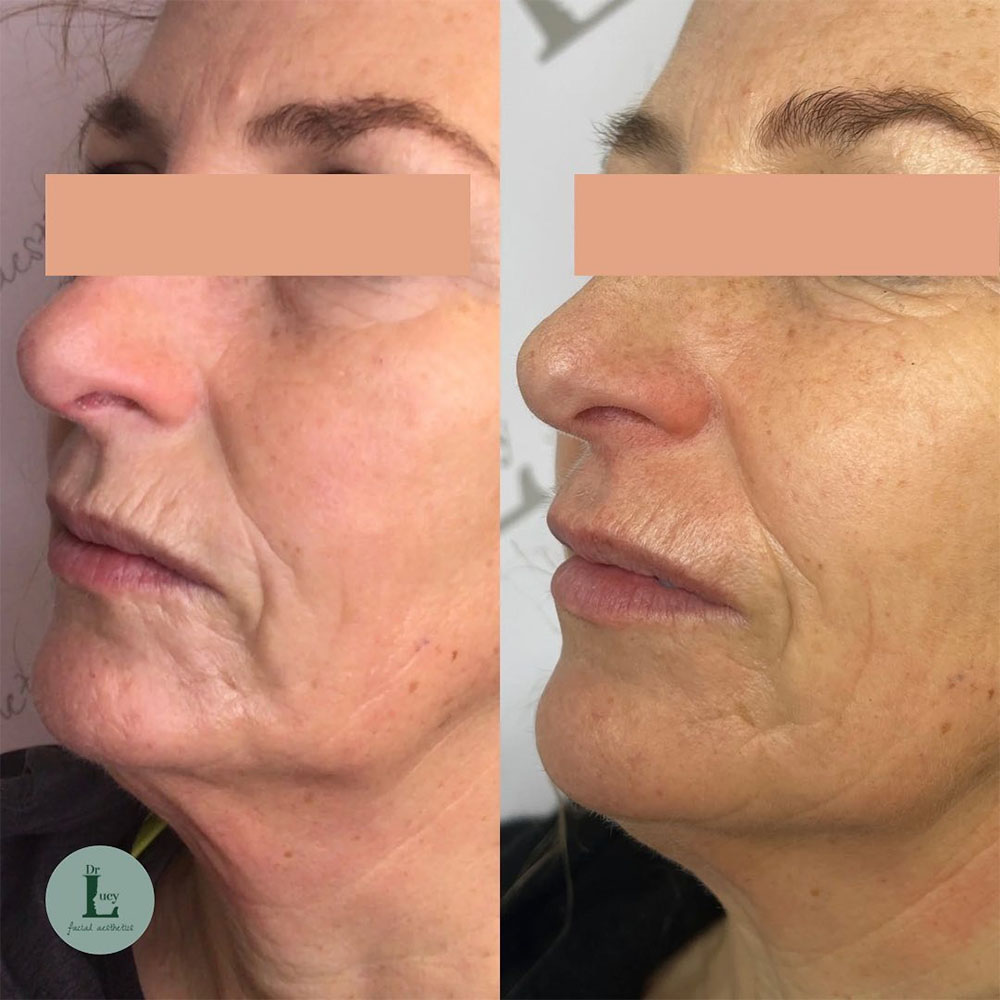 filler for vertical lip lines before and after
