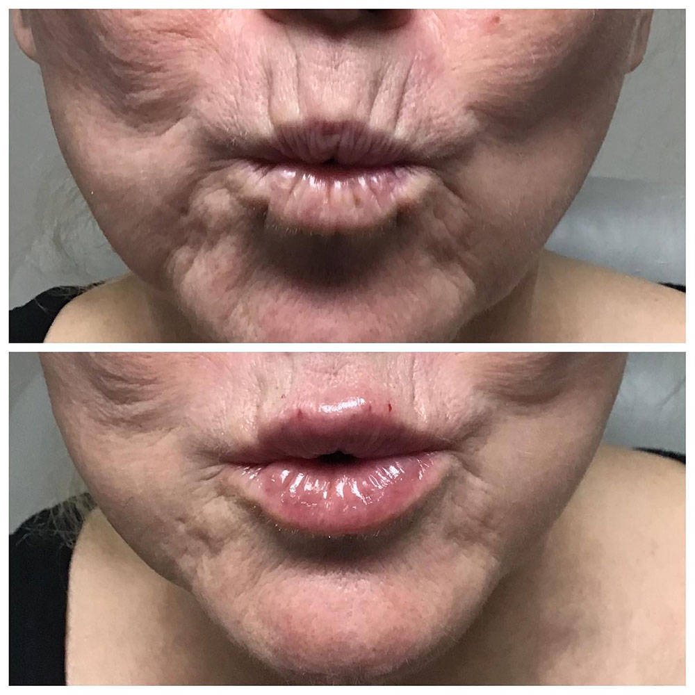 filler for vertical lip lines before and after